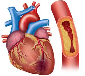 علل و علائم ابتلا به افزایش چربی در اطراف قلب